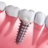 Health Conditions That Can Affect Your Suitability For Dental Implants