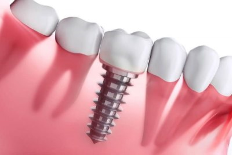 Health Conditions That Can Affect Your Suitability For Dental Implants